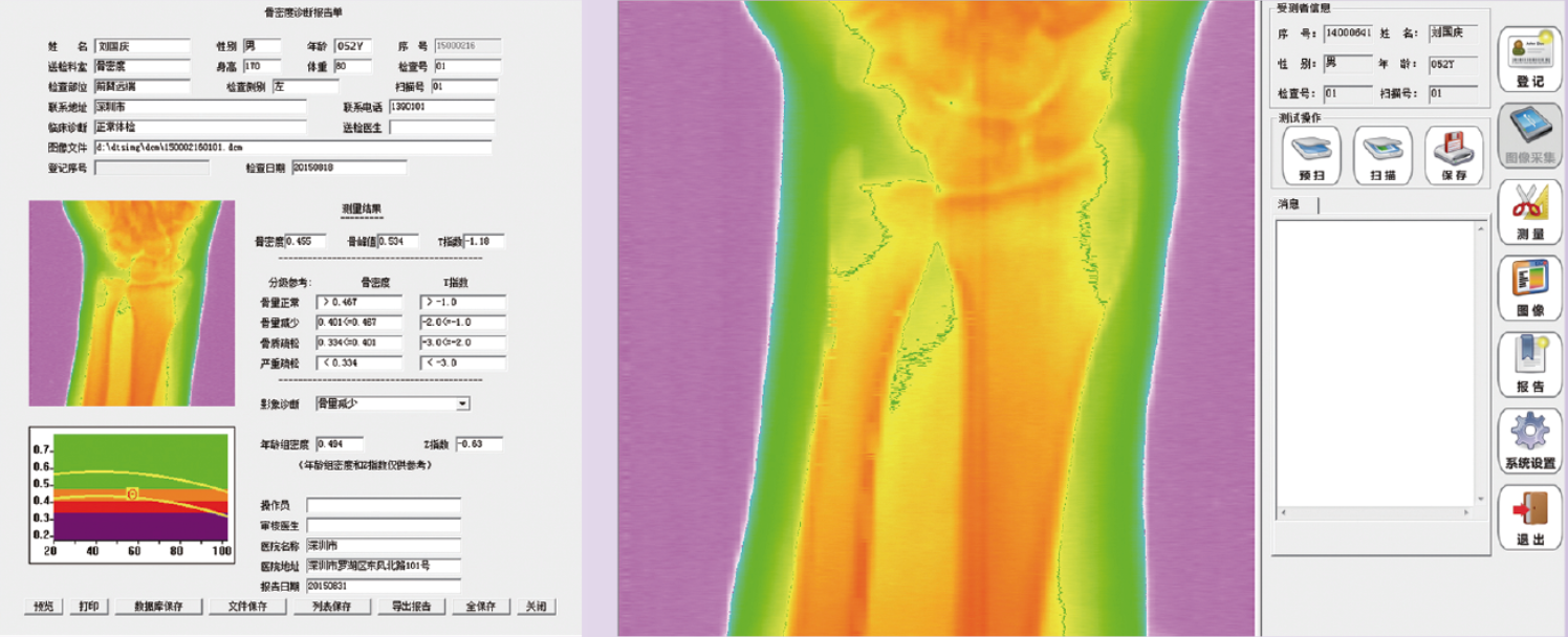 全面报告骨密度诊断相关参数 全面报告骨密度诊断相关参数