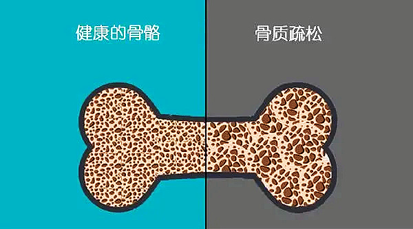心理健康也会影响骨骼健康导致骨质流失？.jpg