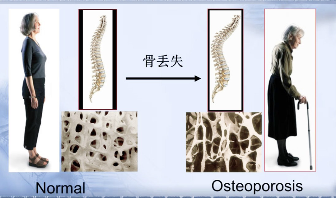 骨质疏松症.jpg